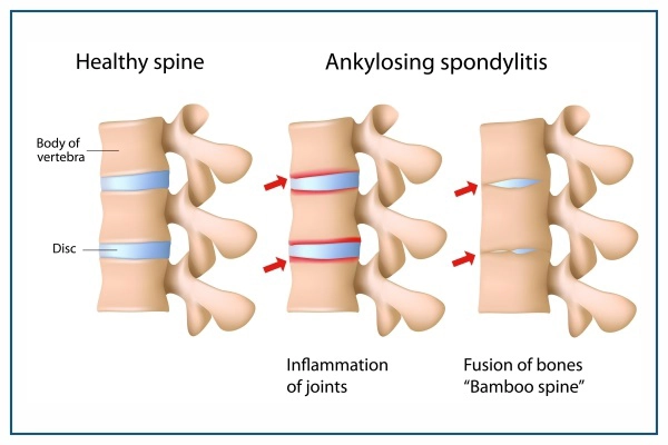spondylosis spondylosis