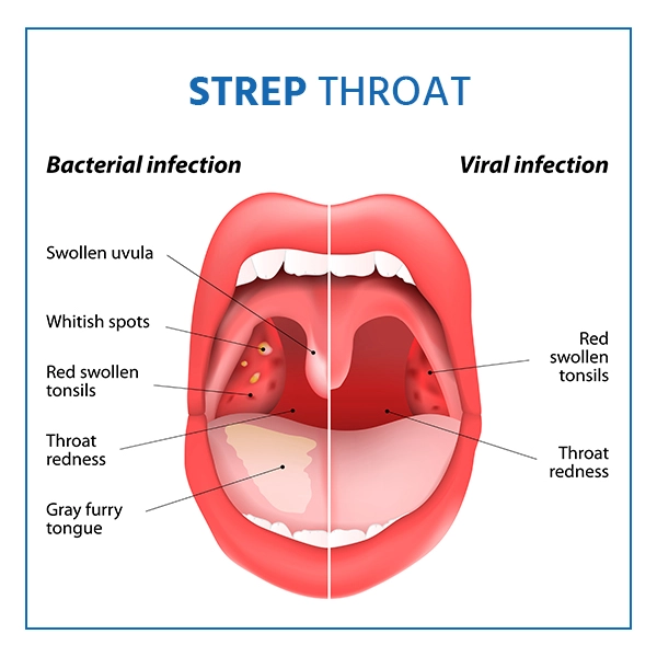 strep-throat-symptoms strep-throat-symptoms