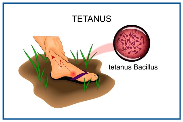 tetanus