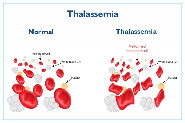Thalassemia