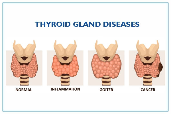 Thyroid Diseases