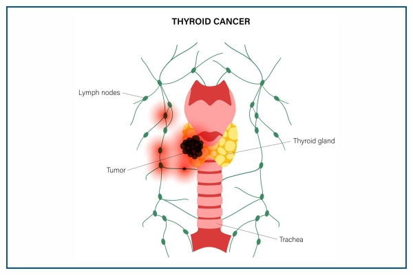 Thyroid Cancer