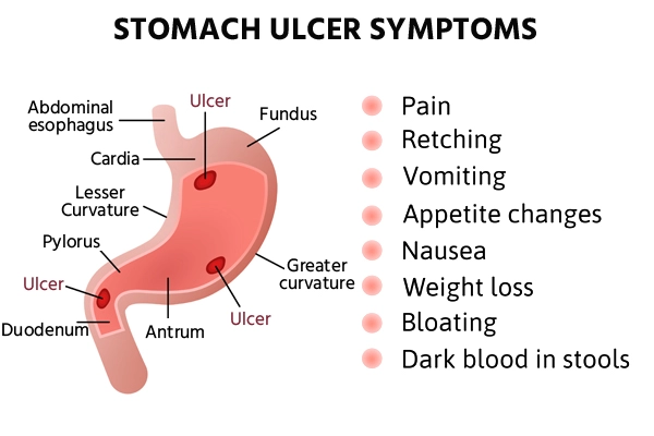 ulcer symptoms ulcer symptoms