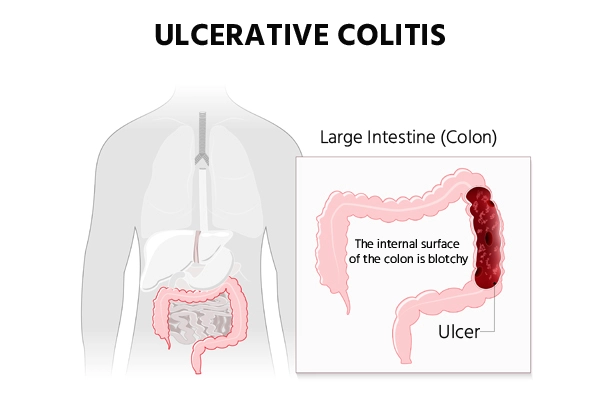 ulcerative-colitis