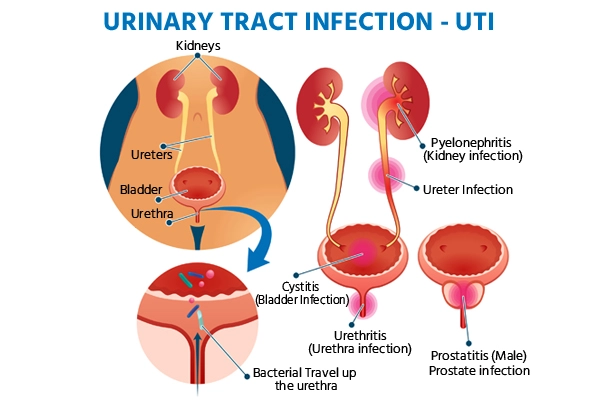 urinary-tract-infection urinary-tract-infection