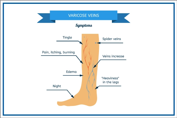 Varicose veins Varicose veins