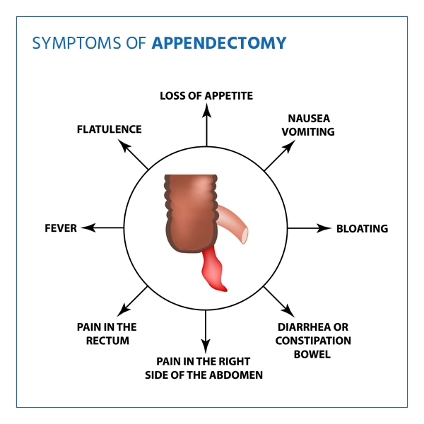 sympyoms of appendectomy
