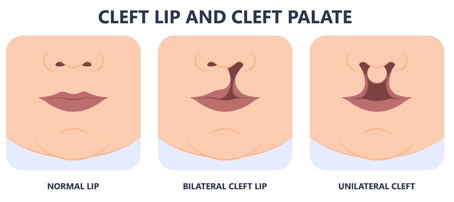 cleft lip and palate