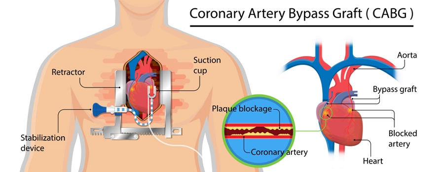 Coronary Artery Bypass Graft coronary artery bypass graft
