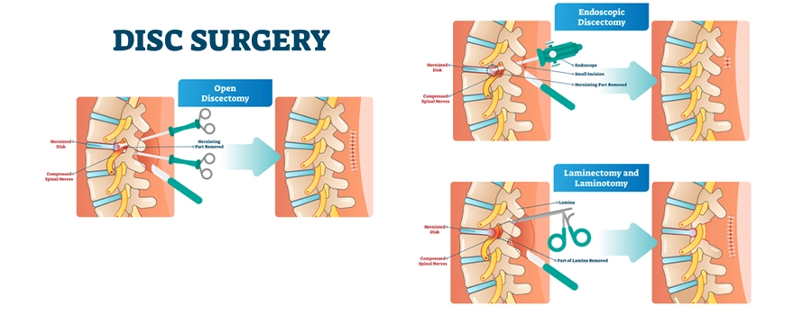 discectomy