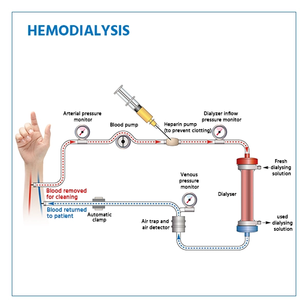 Hemodialysis Hemodialysis