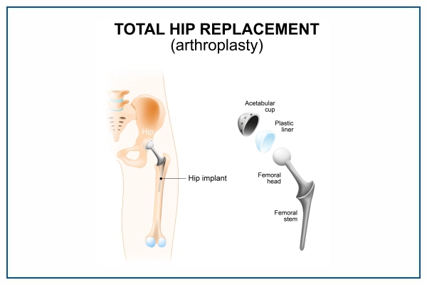 hip replacement surgery