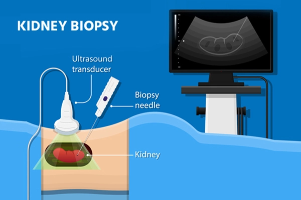 Kidney Biopsy