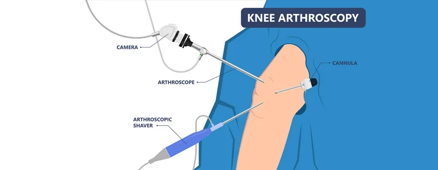 knee-arthroscopy