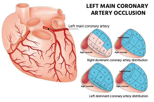 lmca-occlusion