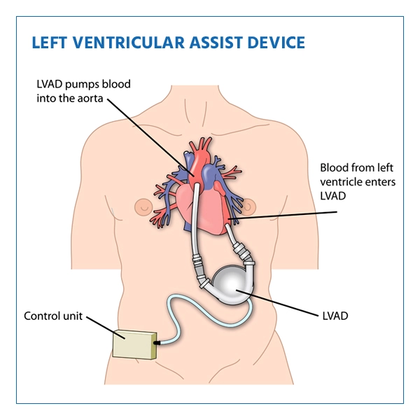 lvad implantation