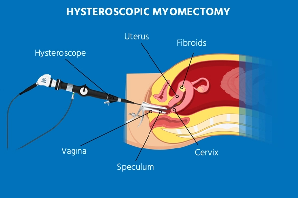 Hysteroscopic myomectomy