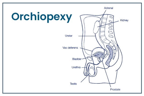 Orchiopexy