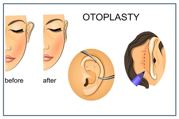 Otoplasty