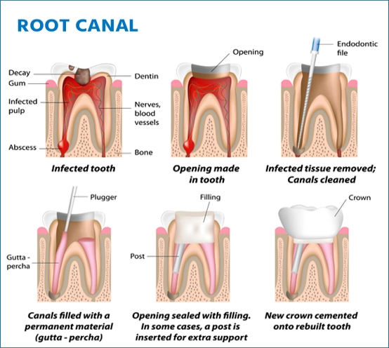 Root Canal