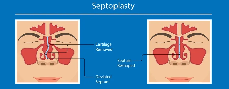 Septoplasty