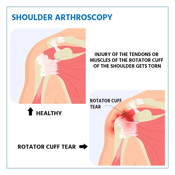 shoulder arthroscopy