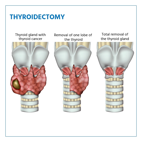 Thyroidectomy