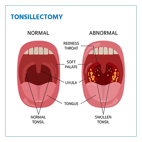 tonsillectomy tonsillectomy