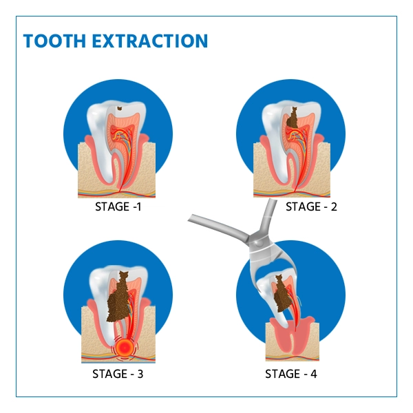 tooth extraction