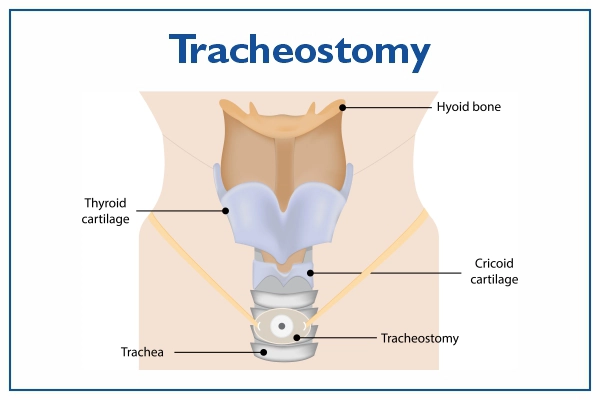Tracheostomy