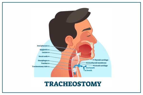 Tracheostomy Procedure