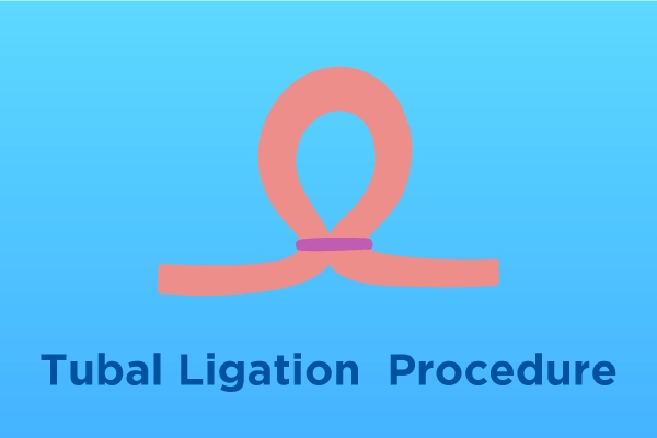 tubal ligation