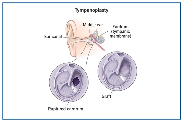Tympanoplasty