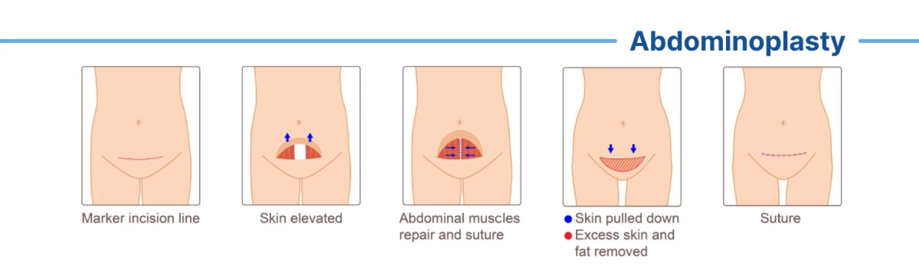 Abdominoplasty or Tummy Tuck surgery