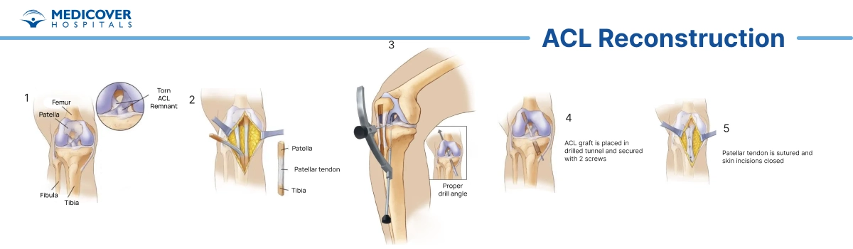 ACL Reconstruction Procedure