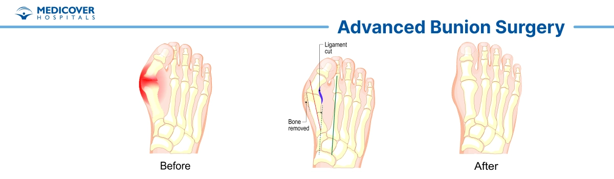 Bunion surgery or hallux valgus correction surgery