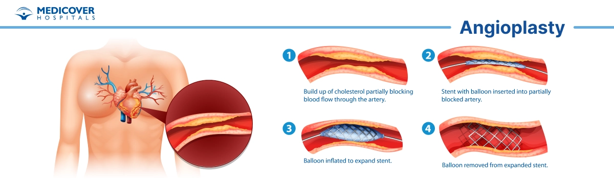 Angioplasty a MIS Procedure