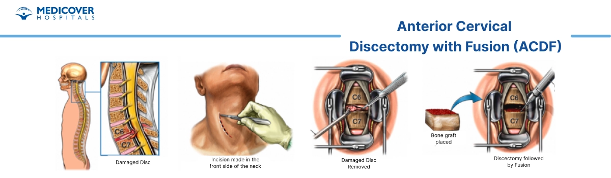 Anterior cervical discectomy and fusion surgery