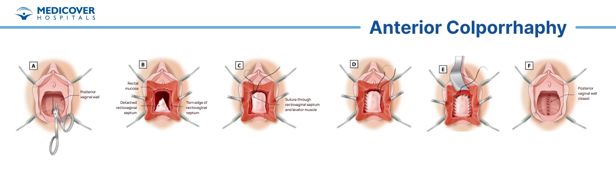 Anterior colporrhaphy procedure