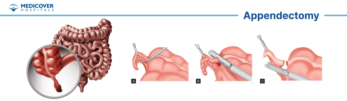 sympyoms of appendectomy