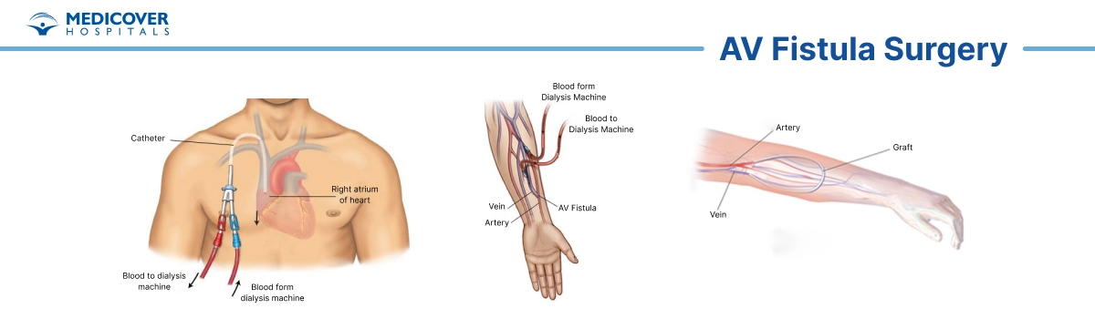 AV fistula surgery