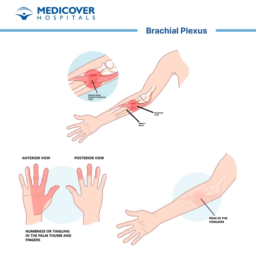 Brachial Plexus Surgery