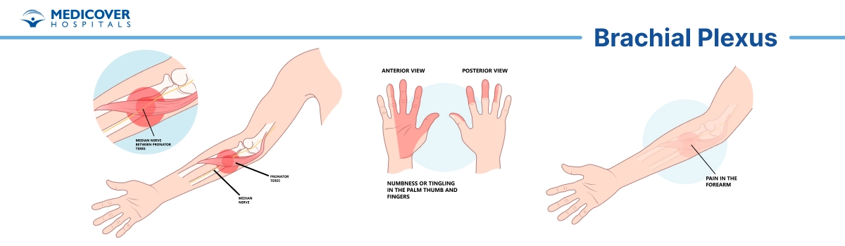 Brachial Plexus Surgery
