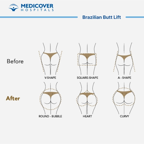 Brazilian Butt Lift