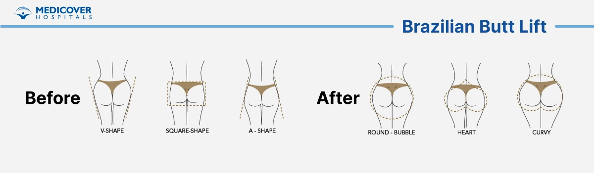 Brazilian Butt Lift