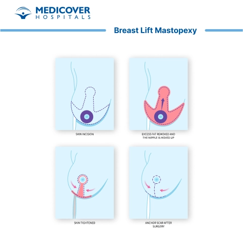 Breast Lift (Mastopexy)