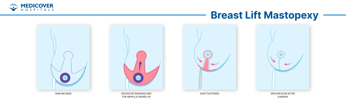 Breast Lift (Mastopexy)
