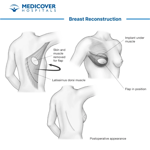 Breast Reconstruction