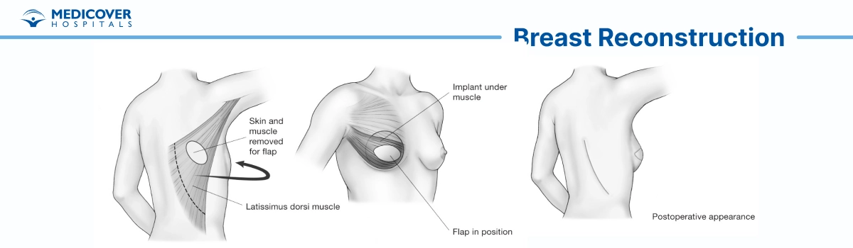 Breast Reconstruction