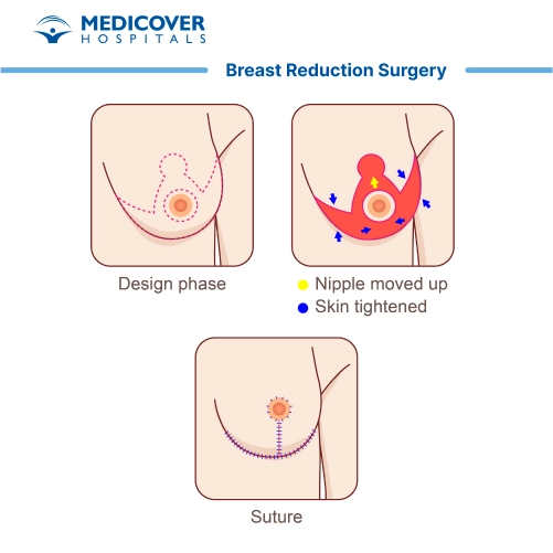 Breast Reduction Surgery